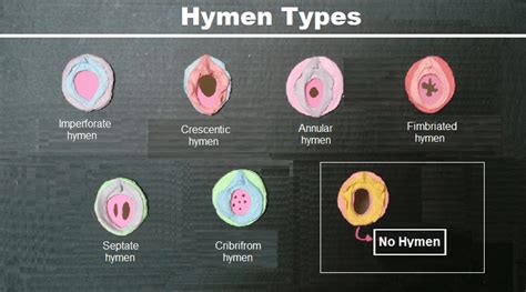 hymen pictures|Types of Hymens